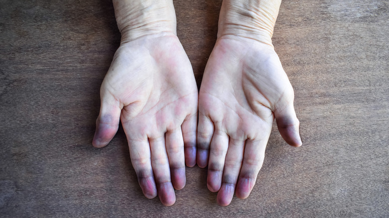 fingertips with peripheral cyanosis