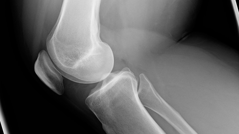 knee with chondromalacia patella