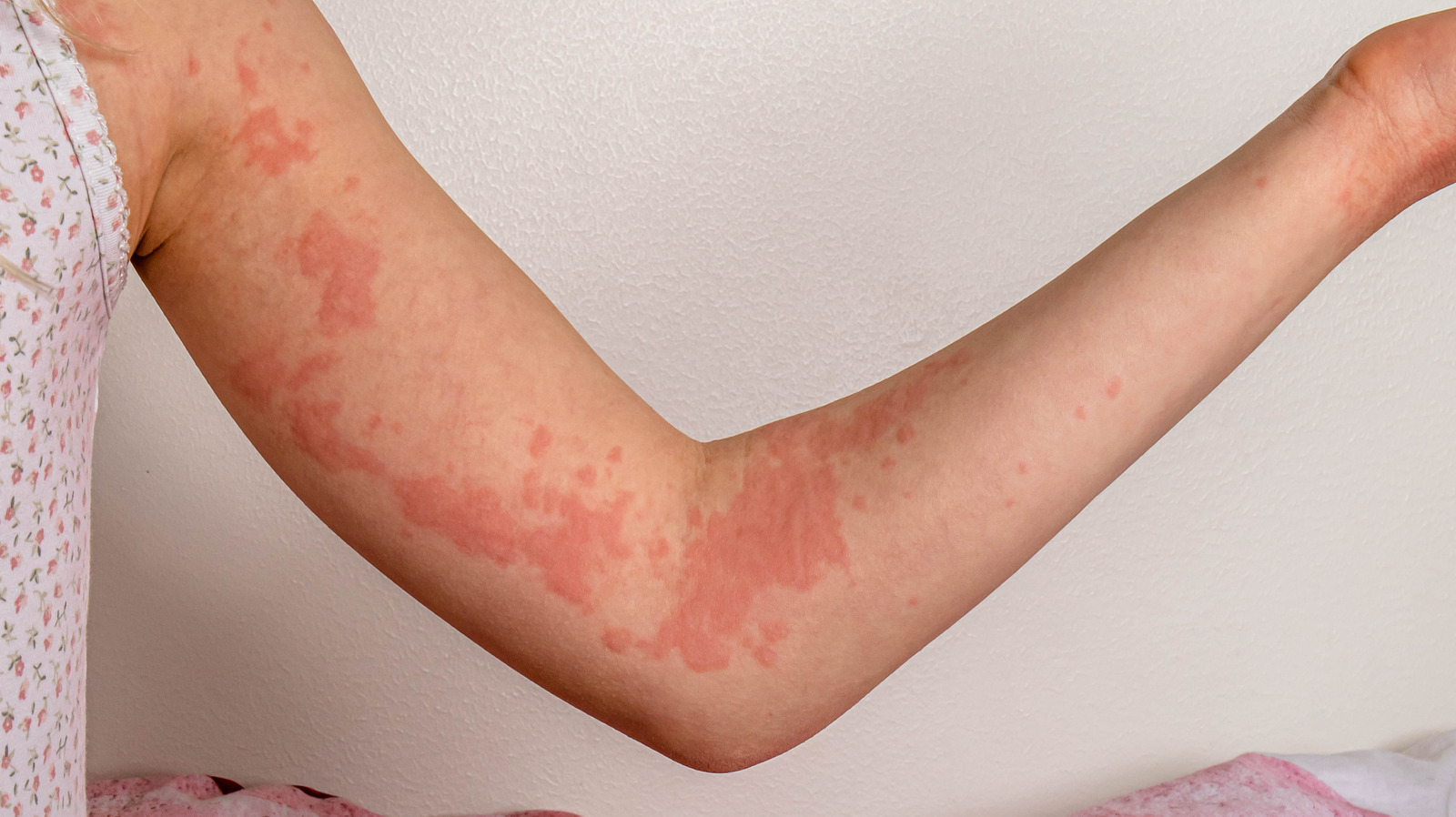 Dr Medico Allergic Reaction Skin Rash Treatment Vrogue Co
