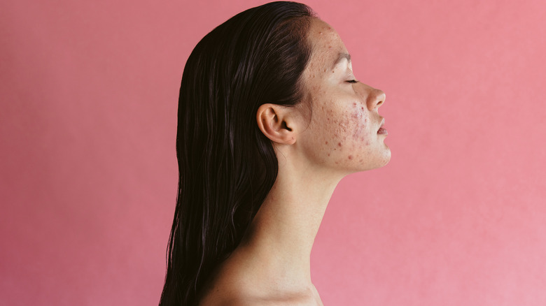 Woman with acne