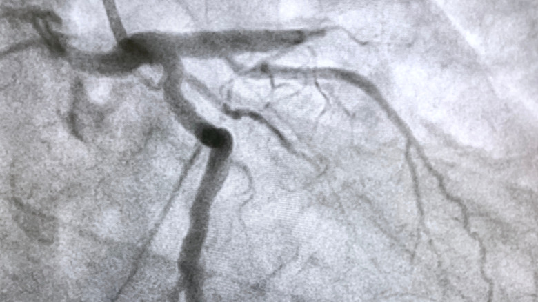 Coronary angiogram