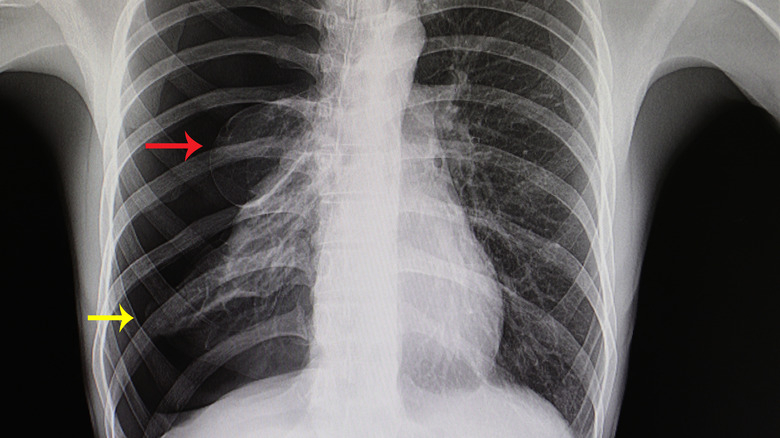 Chest tube