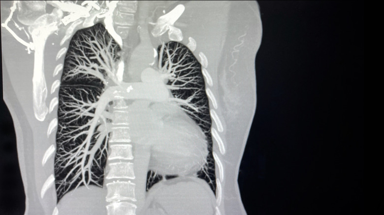 CT Pulmonary Angiography