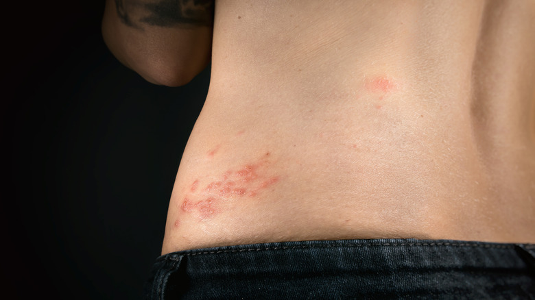 shingles rash