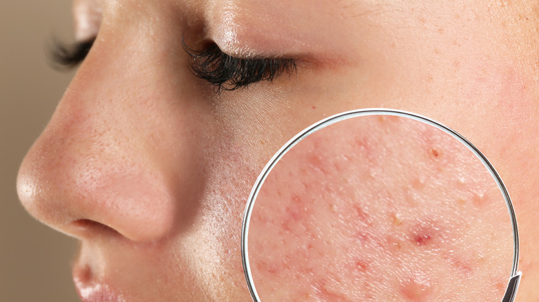 closeup of acne on a girls face