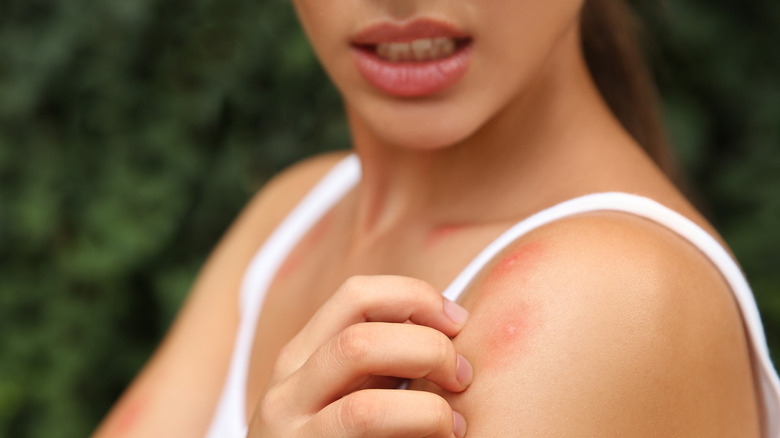 woman with a bug bite on her arm scratching it