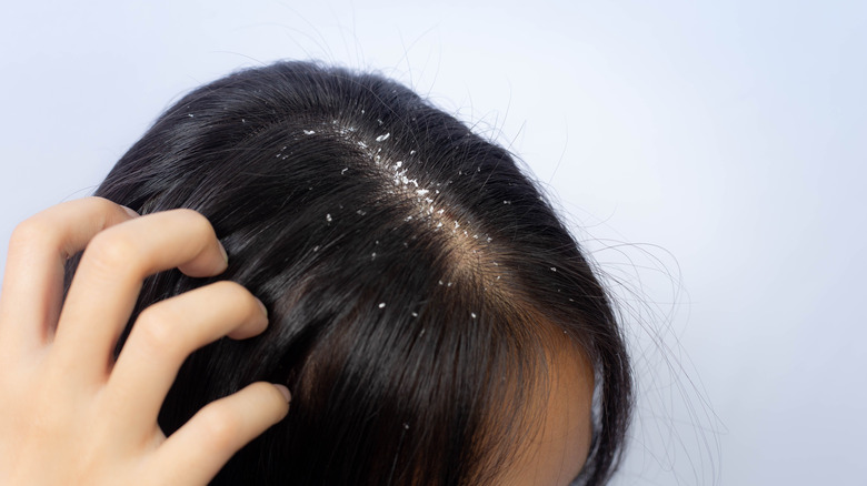 person with dandruff