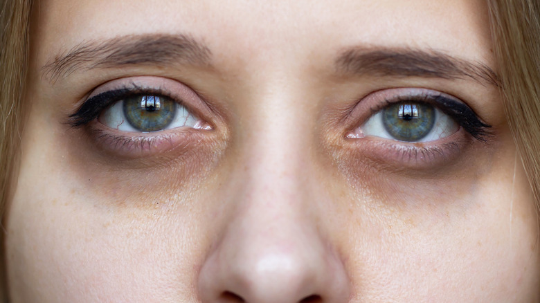 woman looking tired with dark circles under her eyes