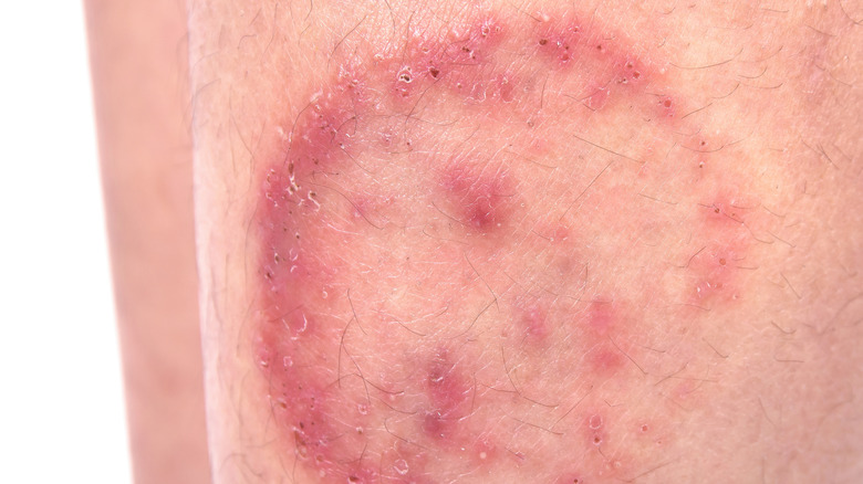 a closeup of ringworm on an arm