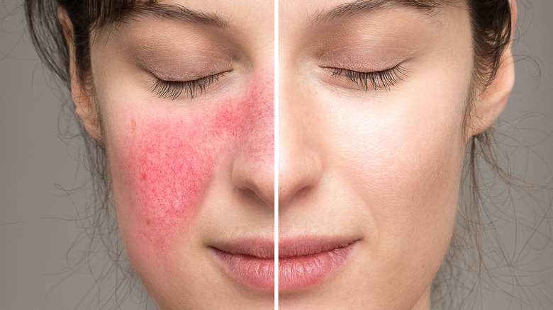 woman with rosacea on her face