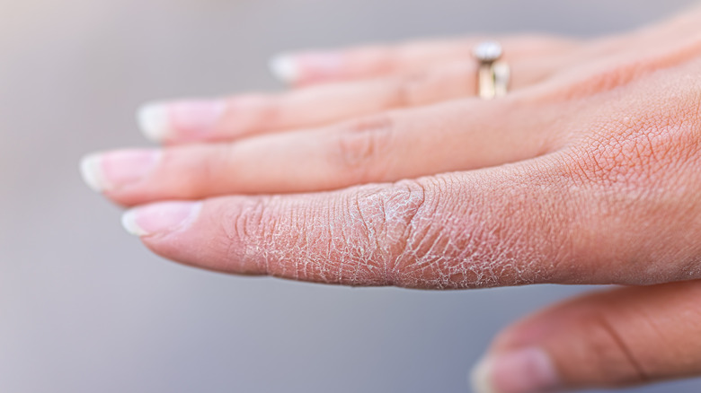 Person with eczema on skin