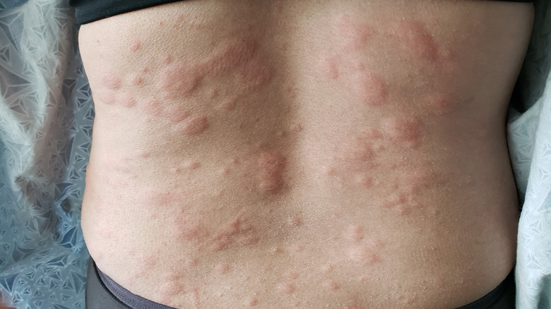 A person with a hives outbreak on their back
