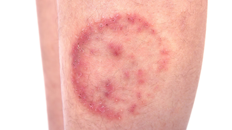 Ringworm on skin