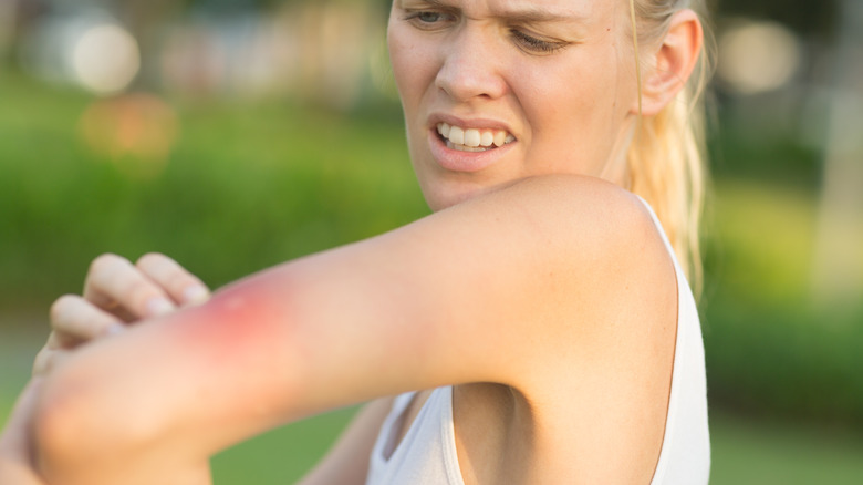 woman with insect bite