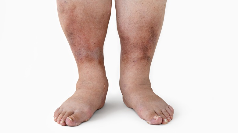 bruised and swollen diabetic neuropathy in legs and feet