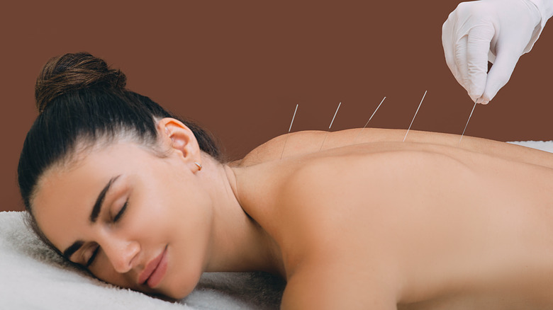 Woman with acupuncture needles in her back