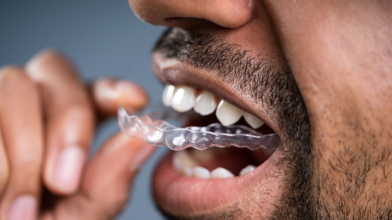 Man putting aligner in mouth