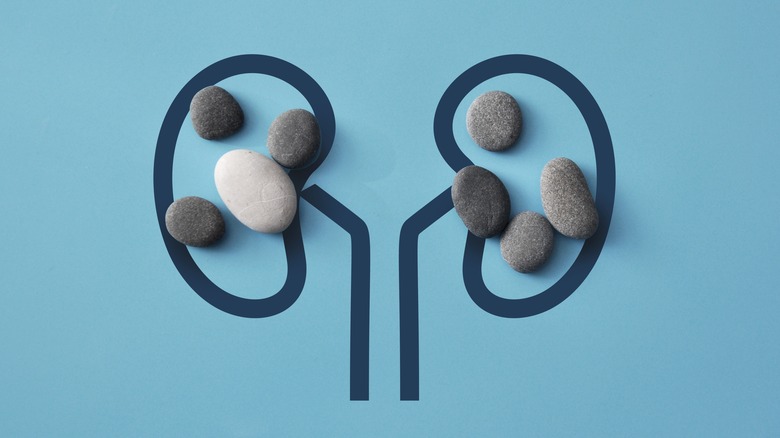 Stones on an illustration of kidneys