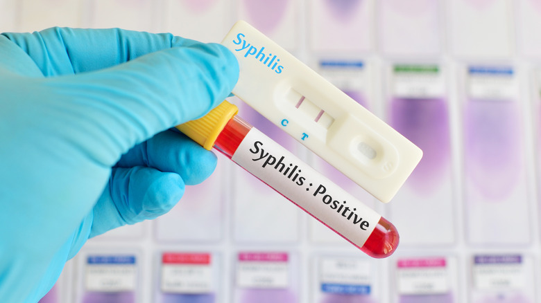 Syphilis testing kit and blood sample testing positive for the STI