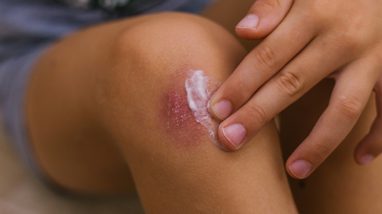 person putting ointment on knee bruise