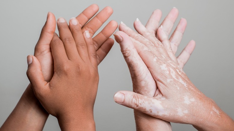 hands with and without vitiligo