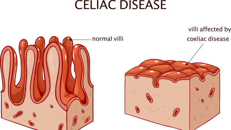 illustration showing flattened intestinal villi in celiac disease