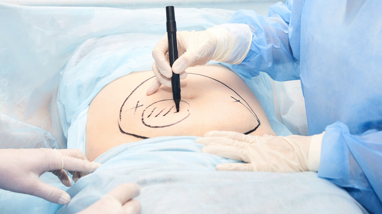 Surgeon marking tummy tuck