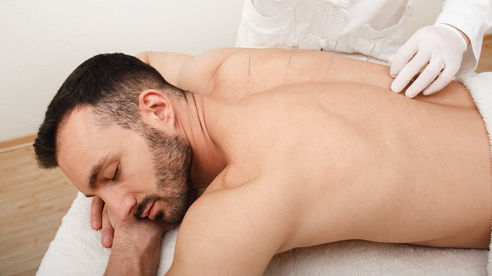 Man receives acupuncture on his back