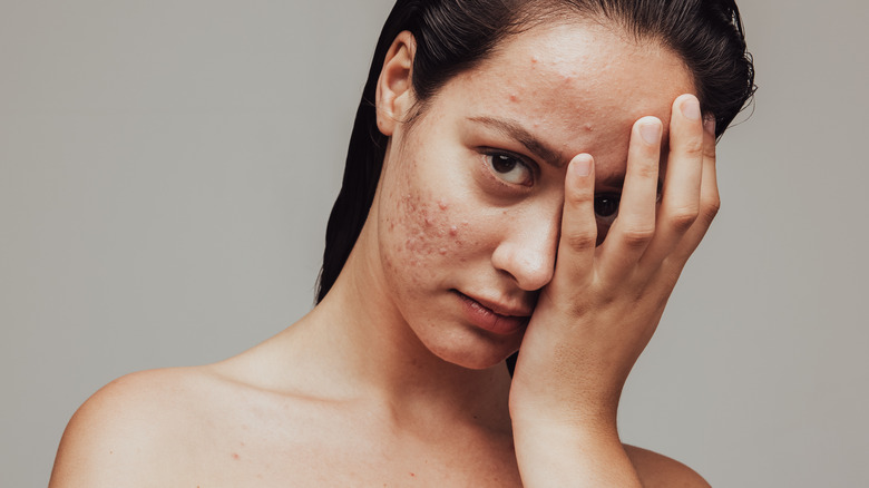 Woman with acne covering face
