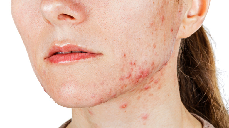 Woman with acne on face