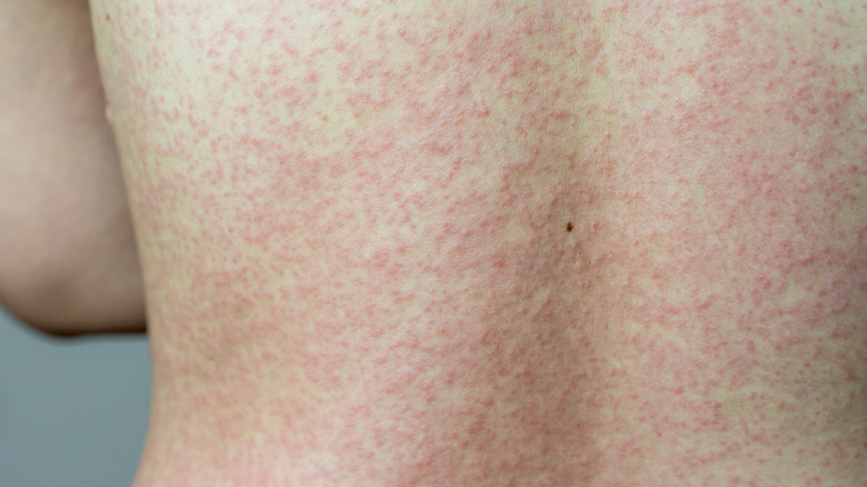 closeup of allergic rash on back