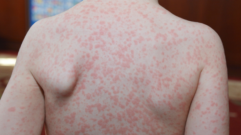 young boy's back with red rashes