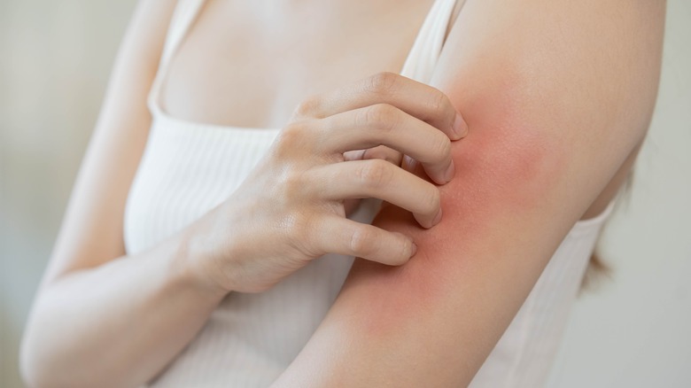 woman scratching arm rash