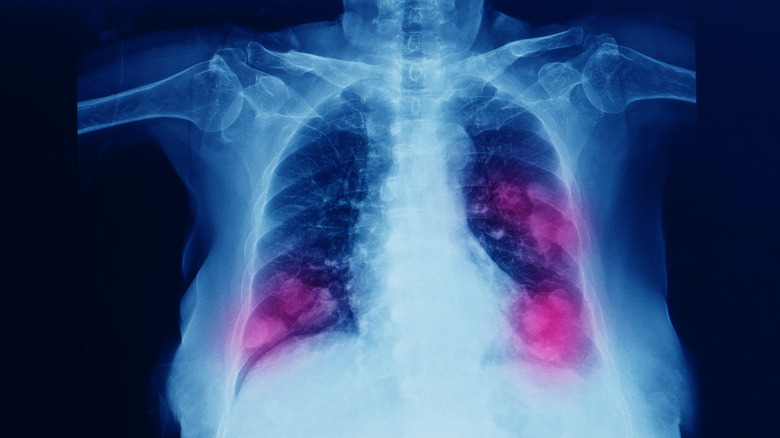 X-Ray of a patient with lung cancer