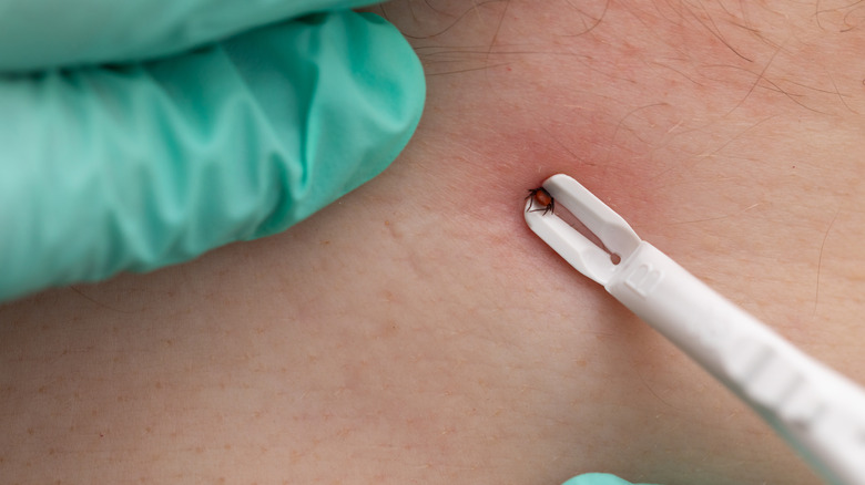 Tweezers pulling out tick from skin