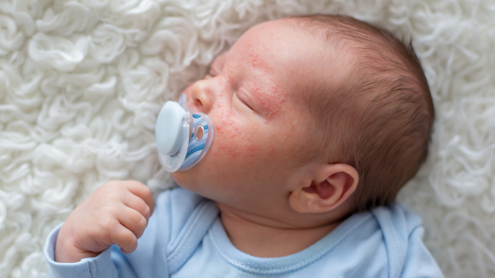 baby-acne-explained-causes-symptoms-and-treatments