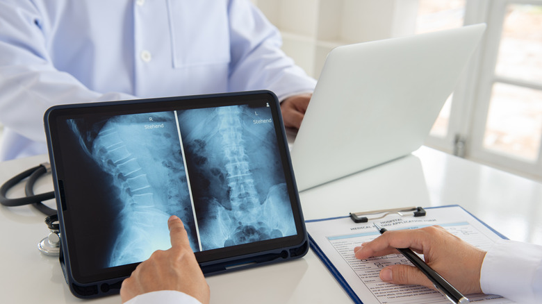 doctor looking at lumbar spine x-ray
