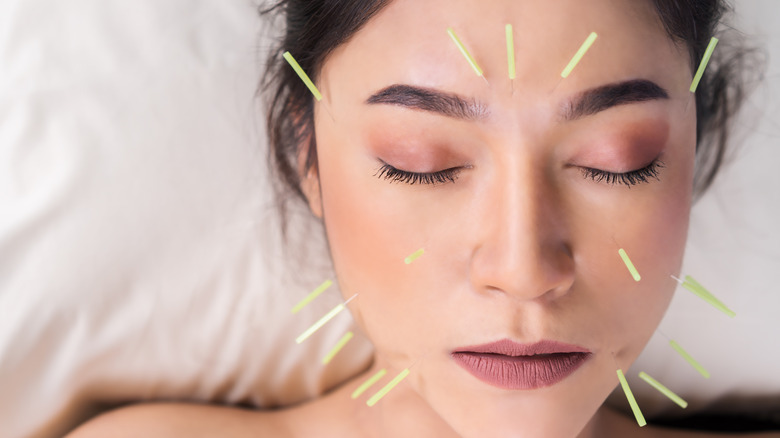 Woman receiving facial acupuncture 