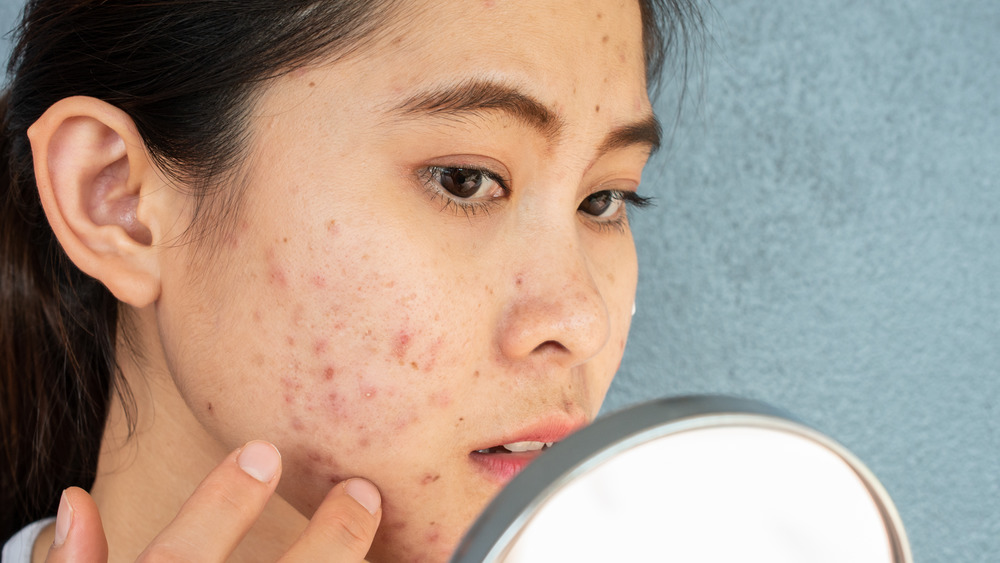 Asian woman looking at her acne-riddled face in the mirror