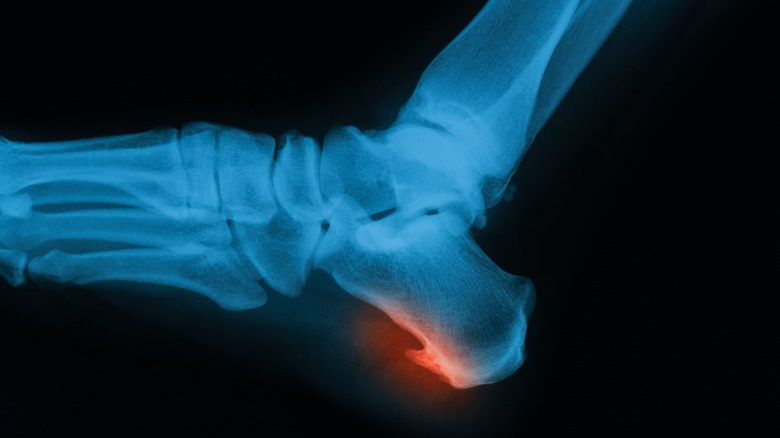 scan of a heel spur