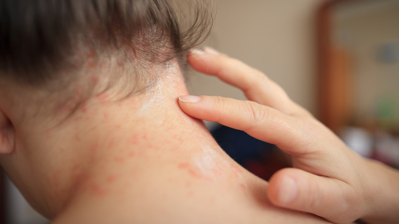 psoriasis on neck