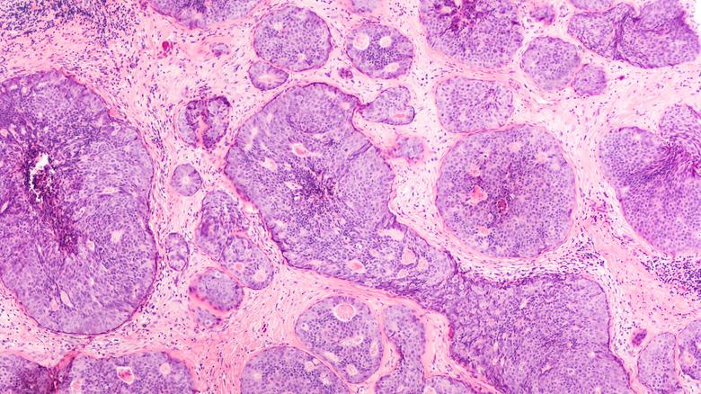 biopsy of breast cancer cells