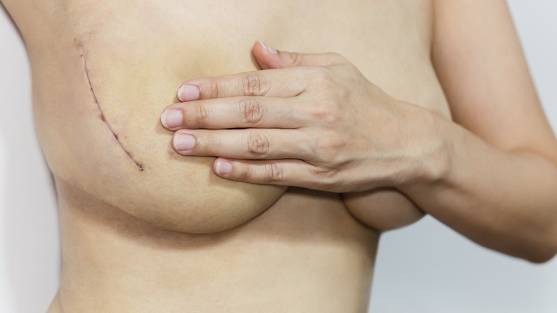 scar from partial mastectomy 