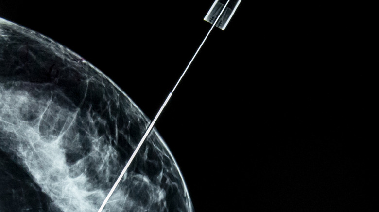 needle biopsy of breast