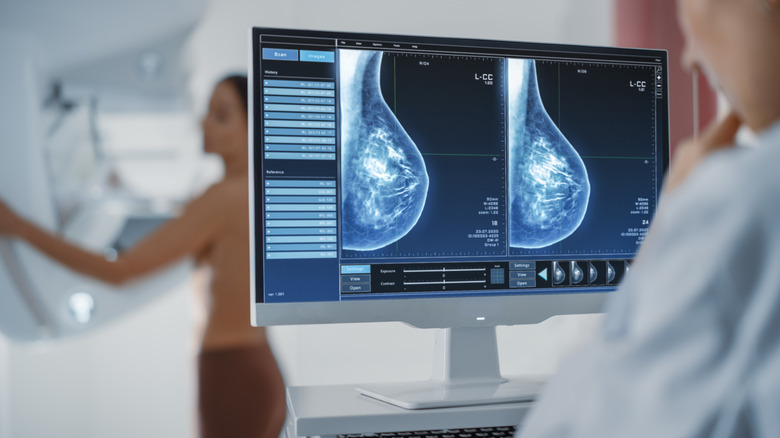 mammogram image of breasts