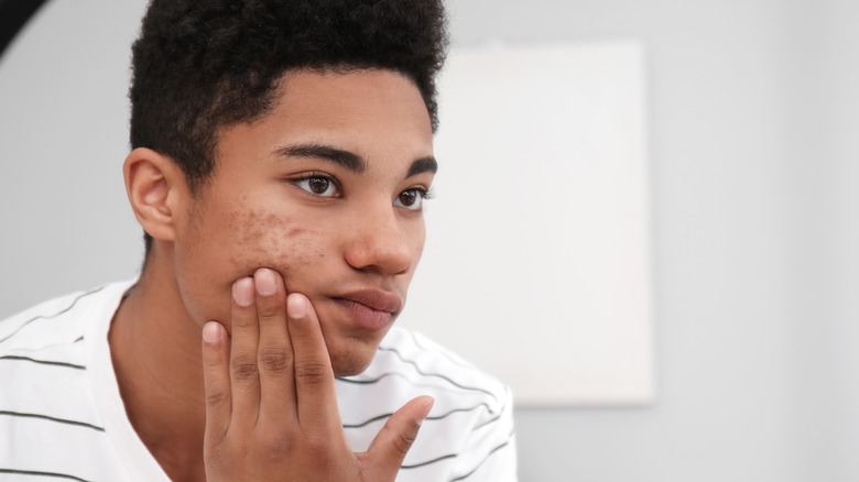 Man looking at acne in mirror 