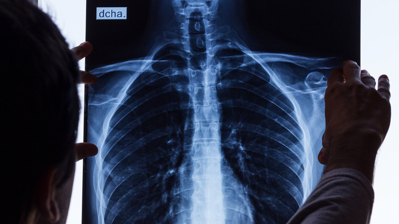 Doctor looking at chest x-ray