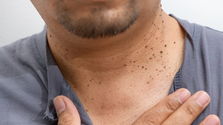 Skin tags on someone's neck