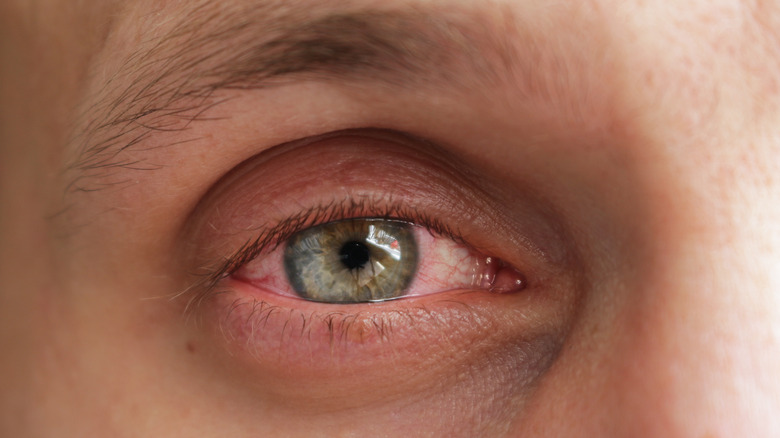 Close up on reddened eye