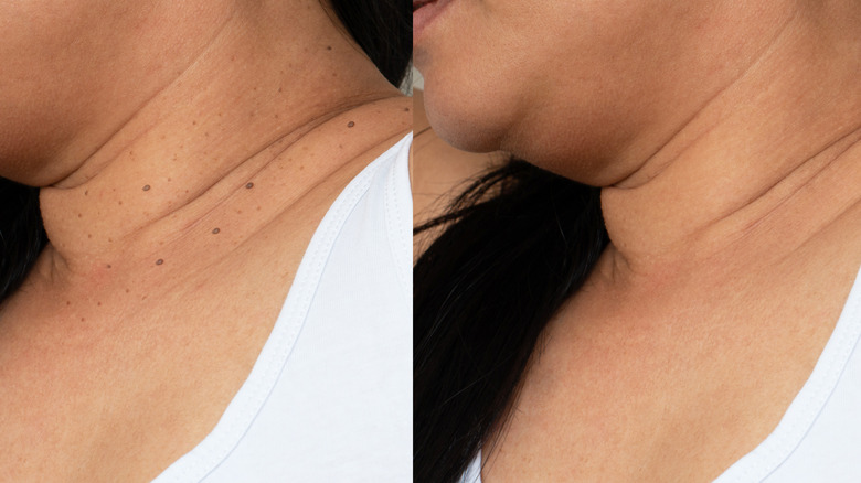 skin tag removal before and after